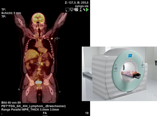 Patient bei Untersuchung im 18F-FDG-PET-CT. Diagnose: nodales Rezidiv eines hochmalignen Lymphoms links axillär und retroperitoneal