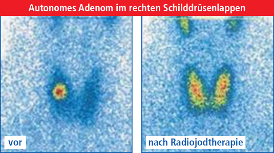 Autonomes Adenom im rechten Schilddrüsenlappen vor und nach der Radiojodtherapie