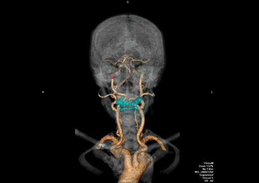 Neuroradiologie, CT: Dreidimensionale Rekonstruktion der Halsgefäße mit Farbmarkierung eingeengter Gefäßabschnitte