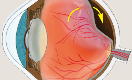 Eine Netzhautablösung entsteht, wenn Flüssigkeit aus dem Glaskörperraum durch einen Riss unter die Netzhaut fließt.