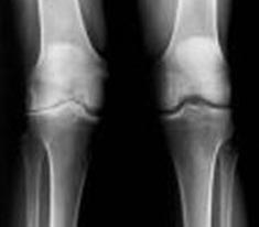 Kniegelenk, linke Seite mit Arthrose, rechte Seite mit normalem Röntgenbild.