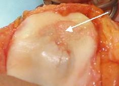 Grosser Knorpeldefekt (Pfeil) hier auf der Rückseite der Kniescheibe.