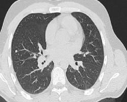 RFA einer Lungenmetastase vor Therapie