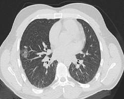 RFA einer Lungenmetastase nach Therapie