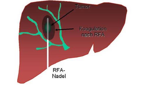 Positionierung der RFA Nadel im Lebertumor