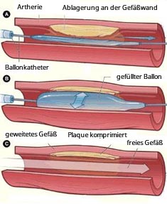 Ballonimplantation