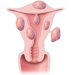 Uterusmyome in unterschiedlicher Größe und Lage innerhalb der Gebärmutter