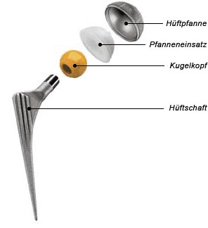 Klinik für Unfallchirurgie und Orthopädie, Handchirurgie, Zementfreie Endoprothese Fa. Zimmer